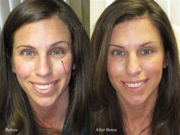 Amy Poehler Plastic Surgery Before and After Botox Injections