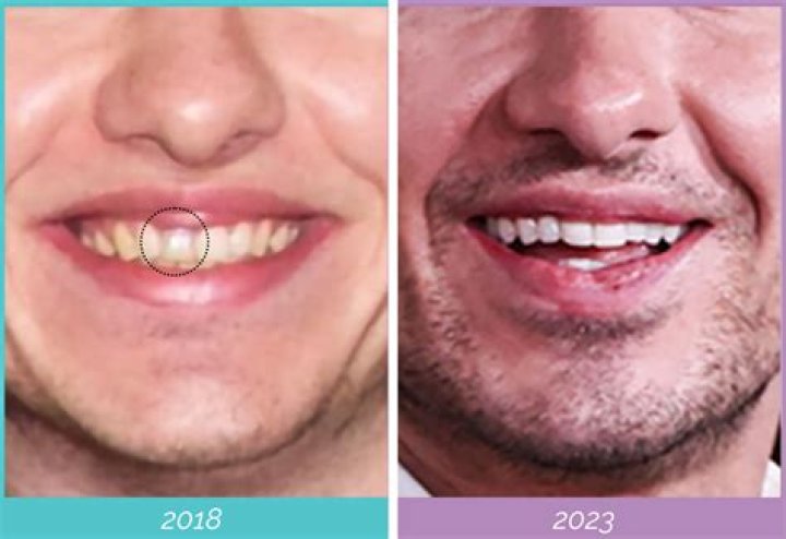 Barry Keoghan’s Plastic Surgery: plastic surgery for jaw reconstruction!
