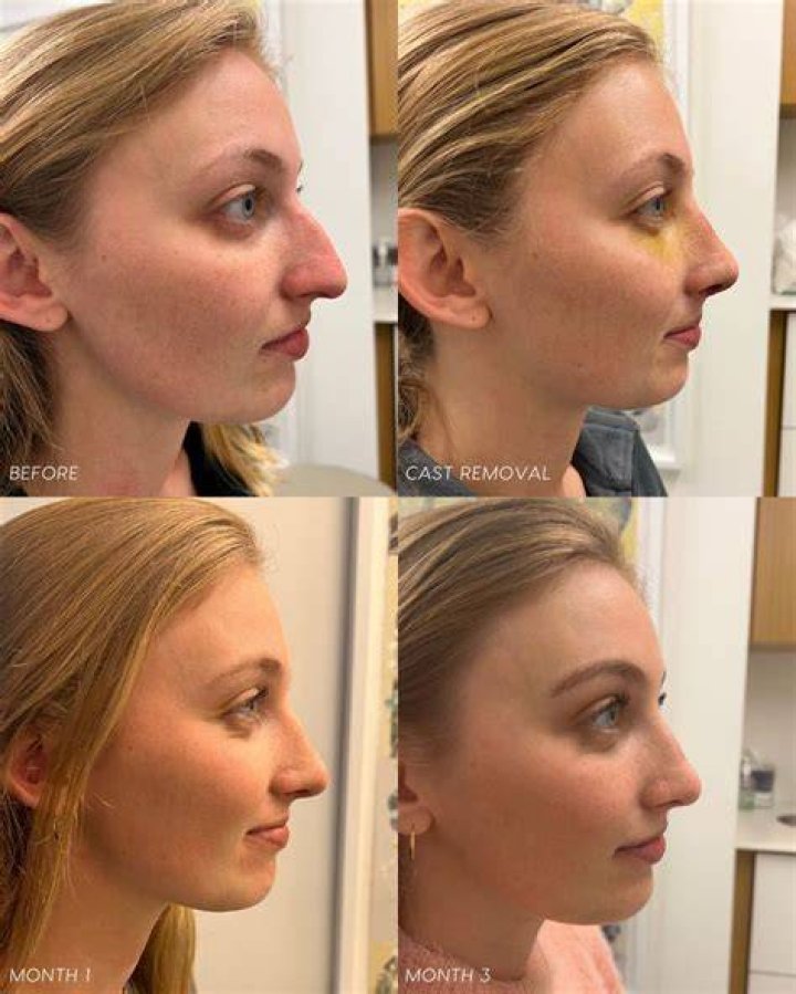 Jill Wagner Plastic Surgery: From Rhinoplasty to Fillers and What Not!